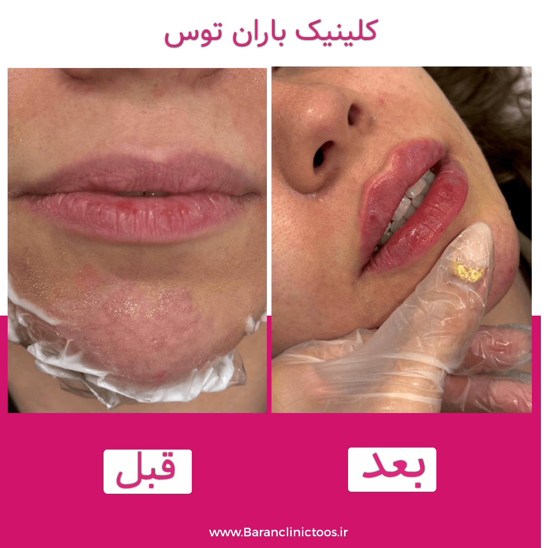 قبل و بعد فیلر لب